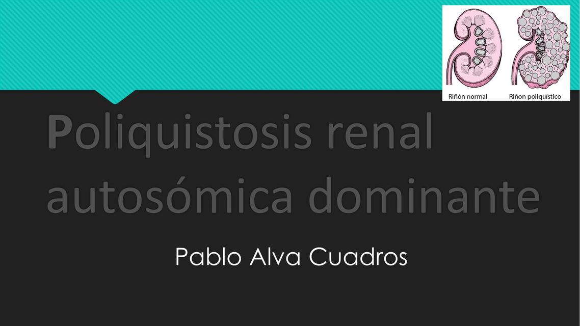 Poliquistosis Renal Autosómica Dominante