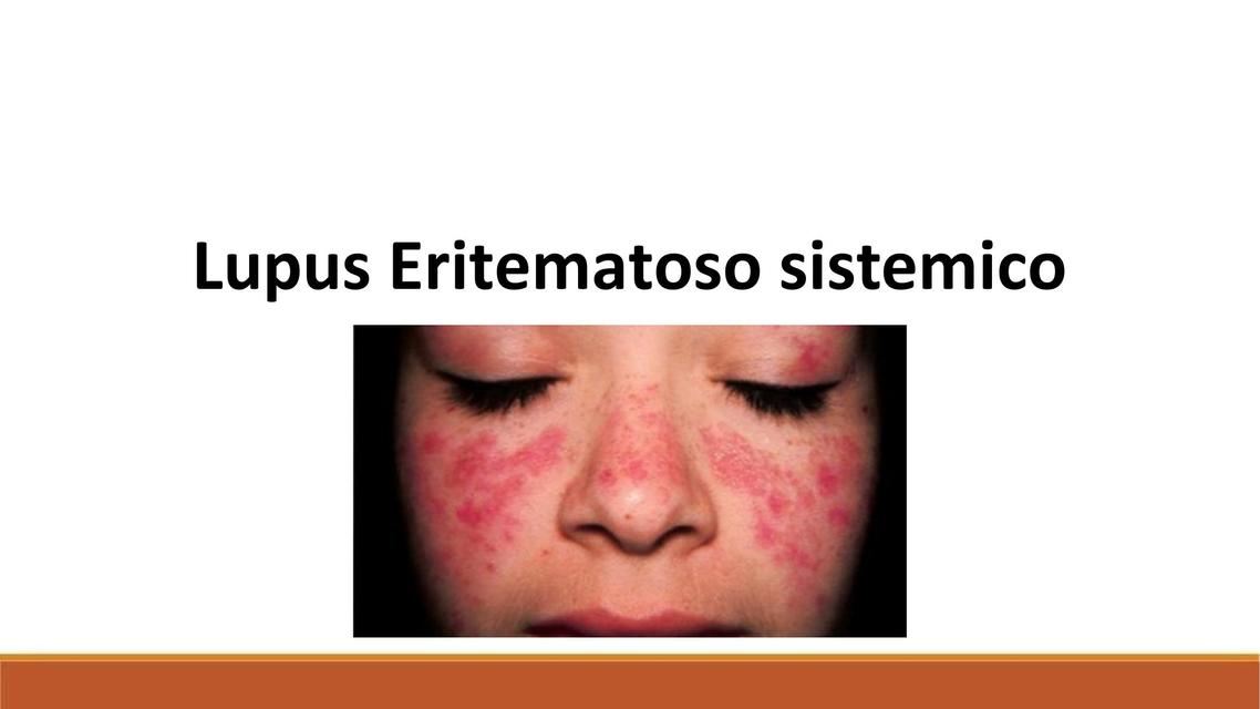 Lupus Eritematoso Sistémico