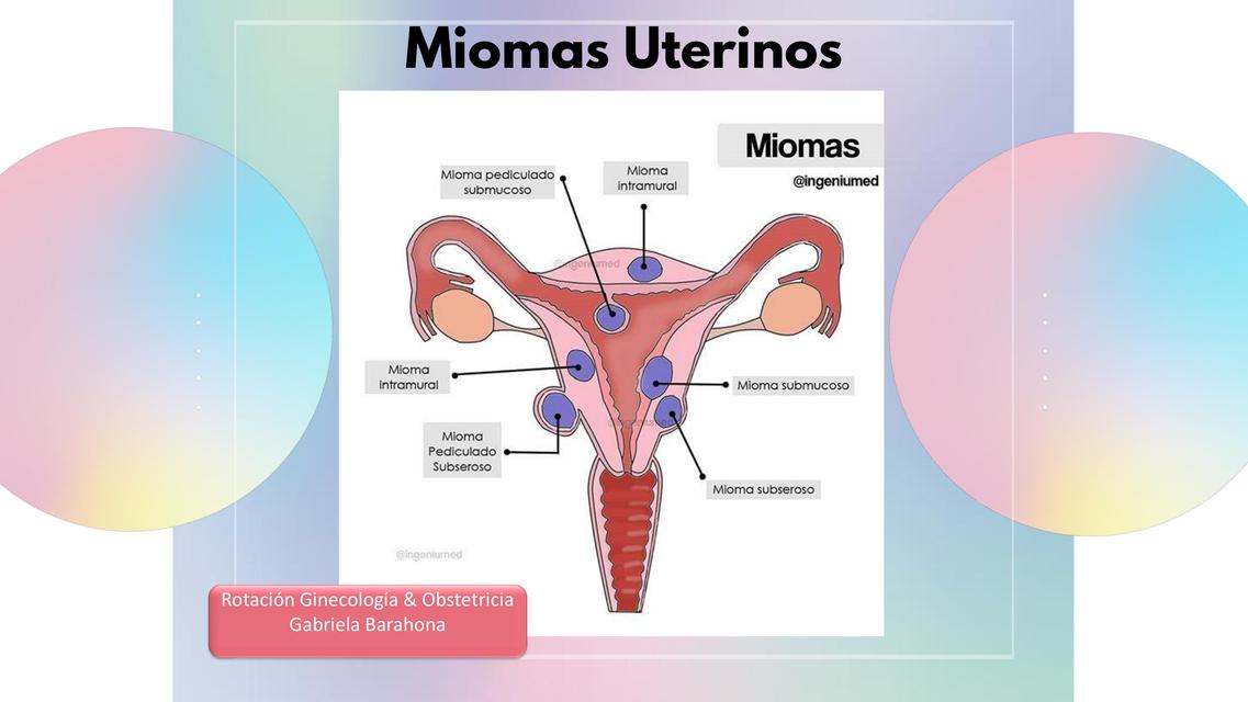 Miomas Uterinos