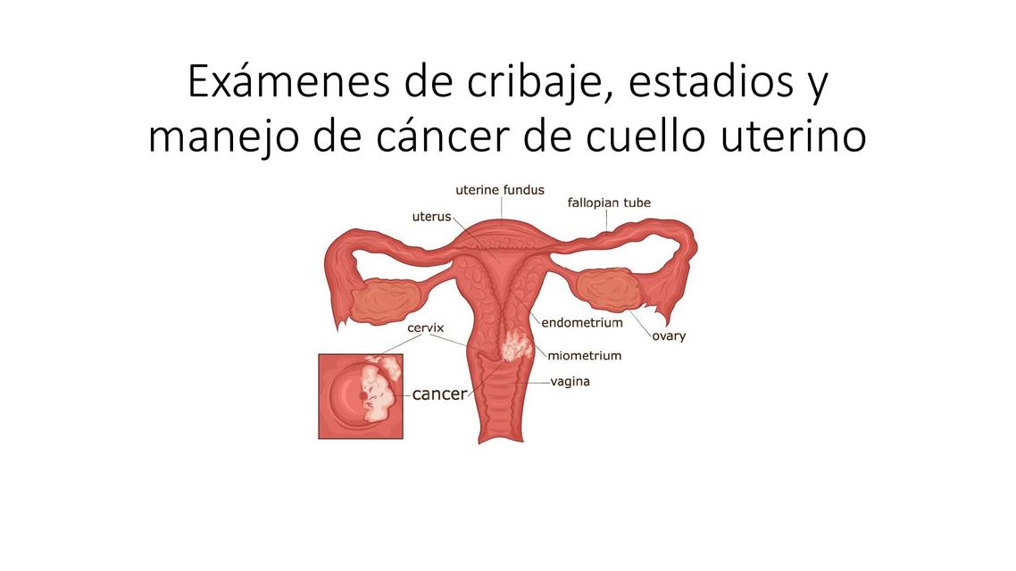 Cáncer de cérvix