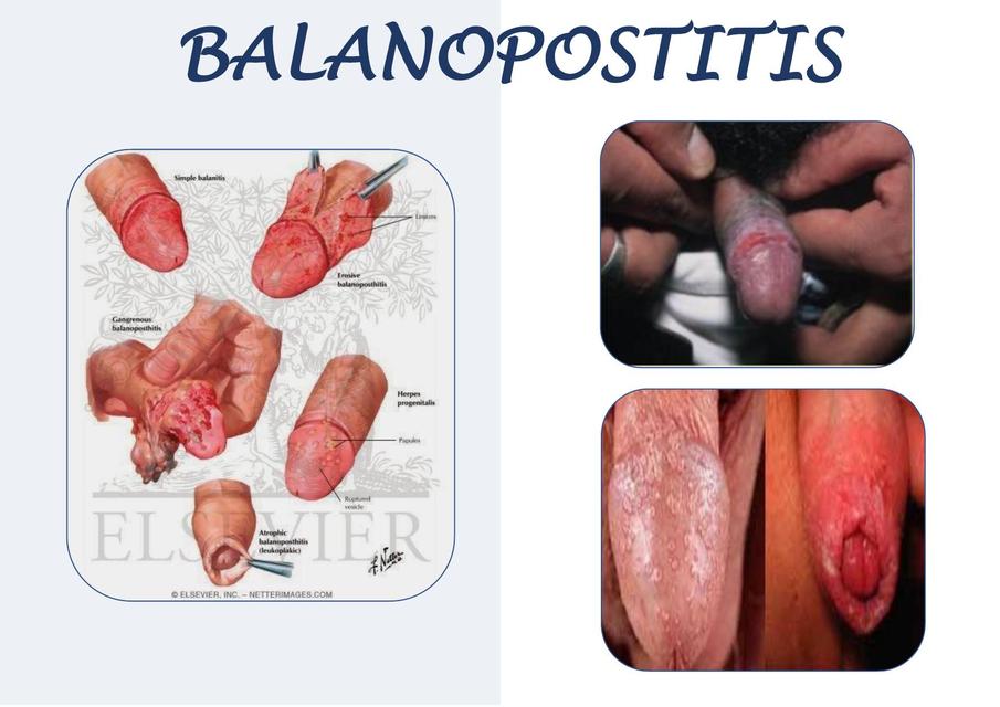 Balanopostitis