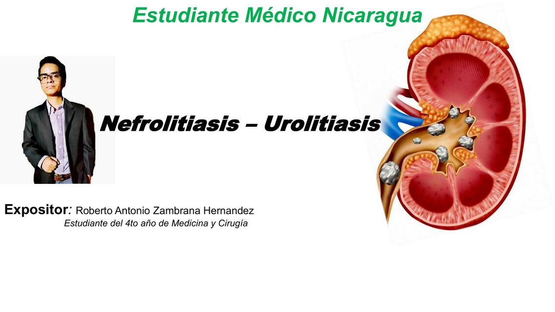 Nefrolitiasis o Urolitiasis