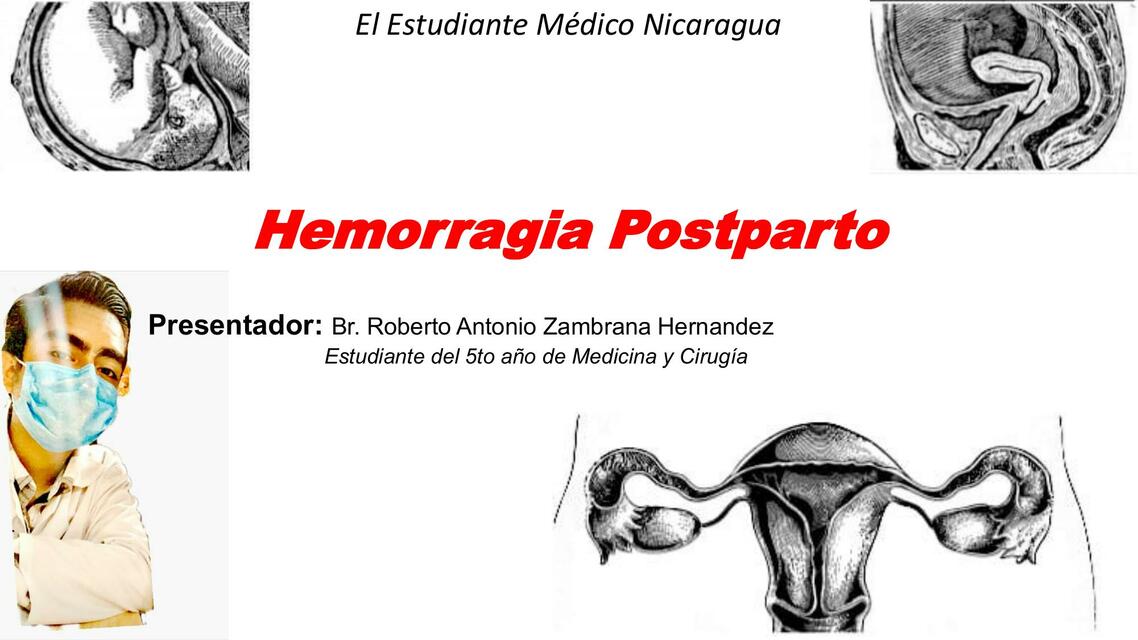 Hemorragia Postparto