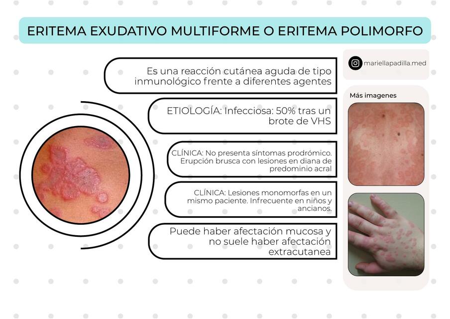 Eritema Exudativo Multiforme 