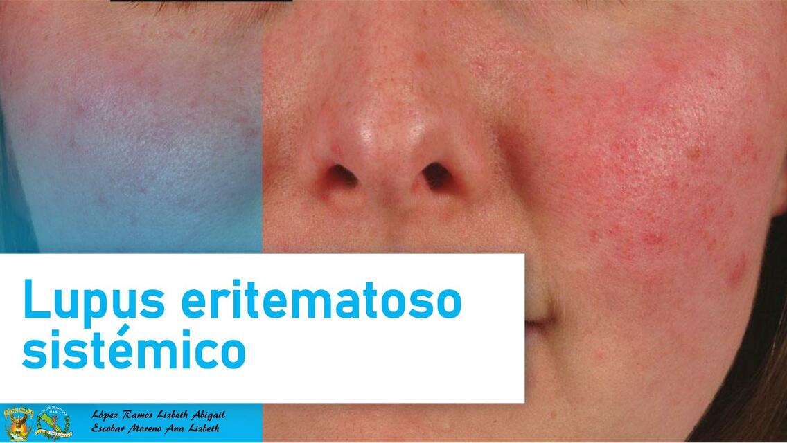 Reumatología Lupus Eritematoso Sistémico 