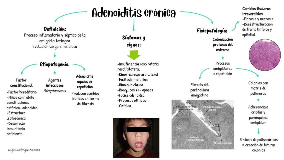 Adenoiditis crónica