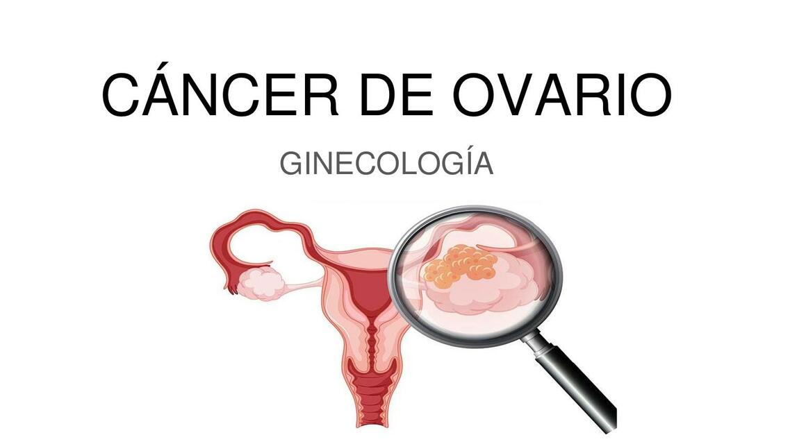 Cáncer de Ovario 