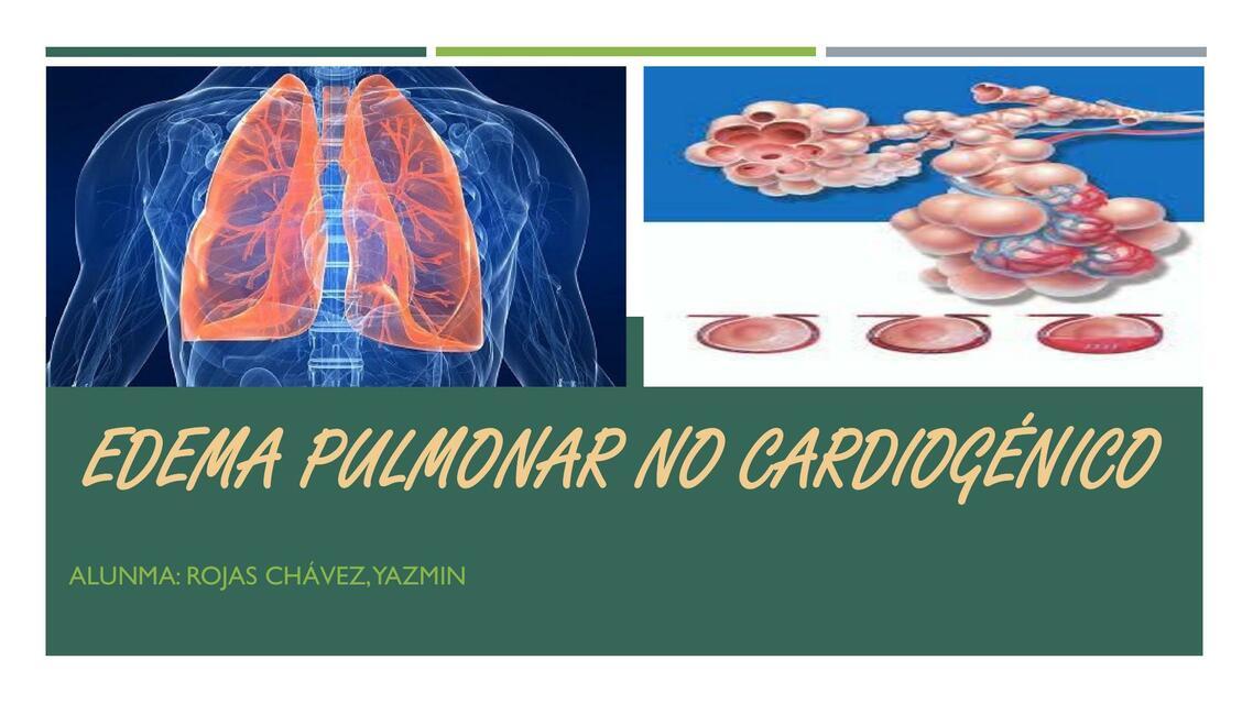 Edema Pulmonar No Cardiogénico 