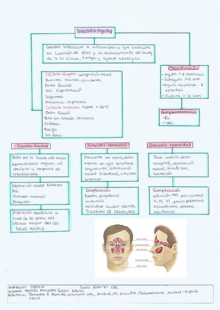 Sinusitis Aguda 