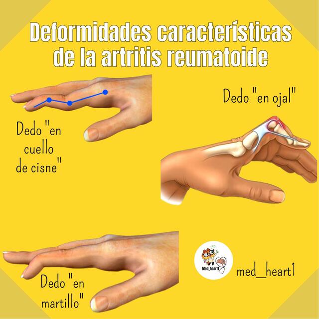 Deformidades Características de la Artritis Reumatoide