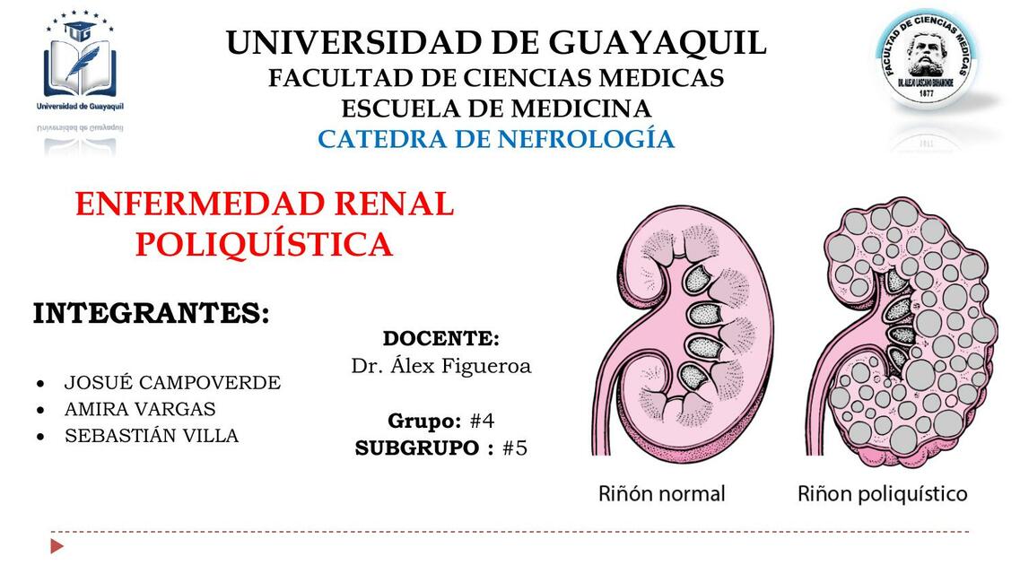 Poliquistosis Renal Exposición Final