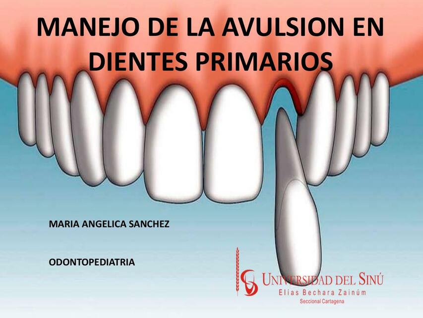 Manejo de la Avulsión en Dientes Primarios