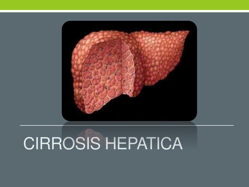 Cirrosis Hepática 