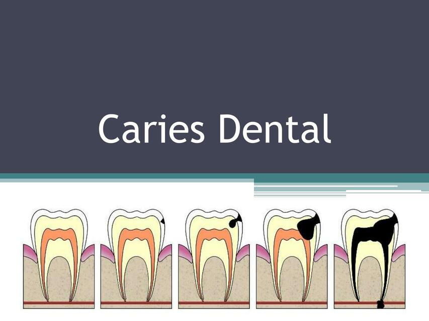 Caries Dental