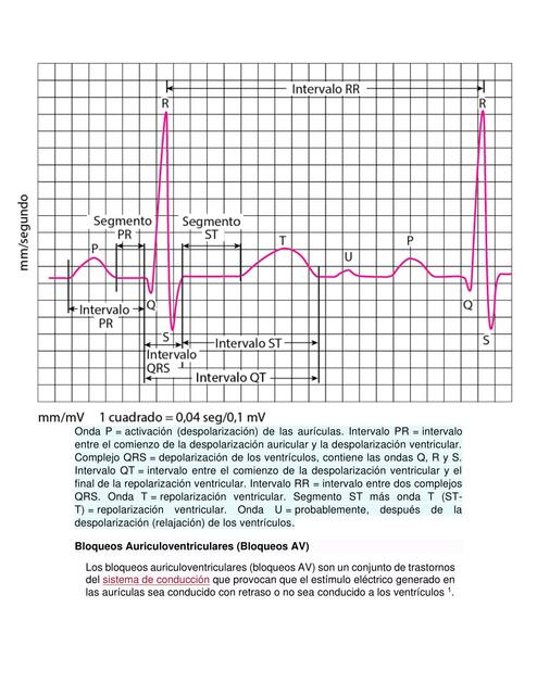 Bloqueos EKG