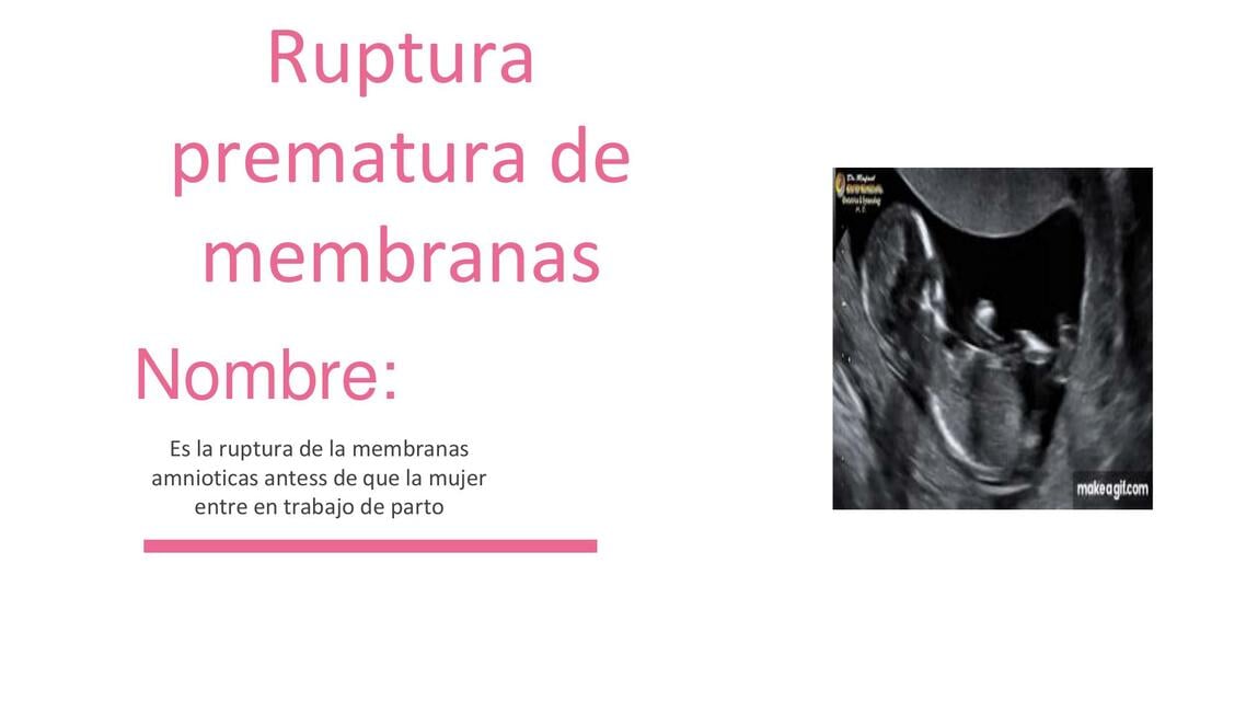 Resúmenes de Ruptura prematura de membranas | Descarga apuntes de