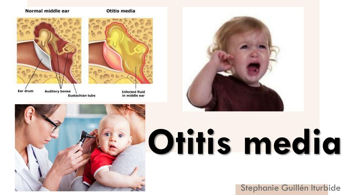 Otitis Media