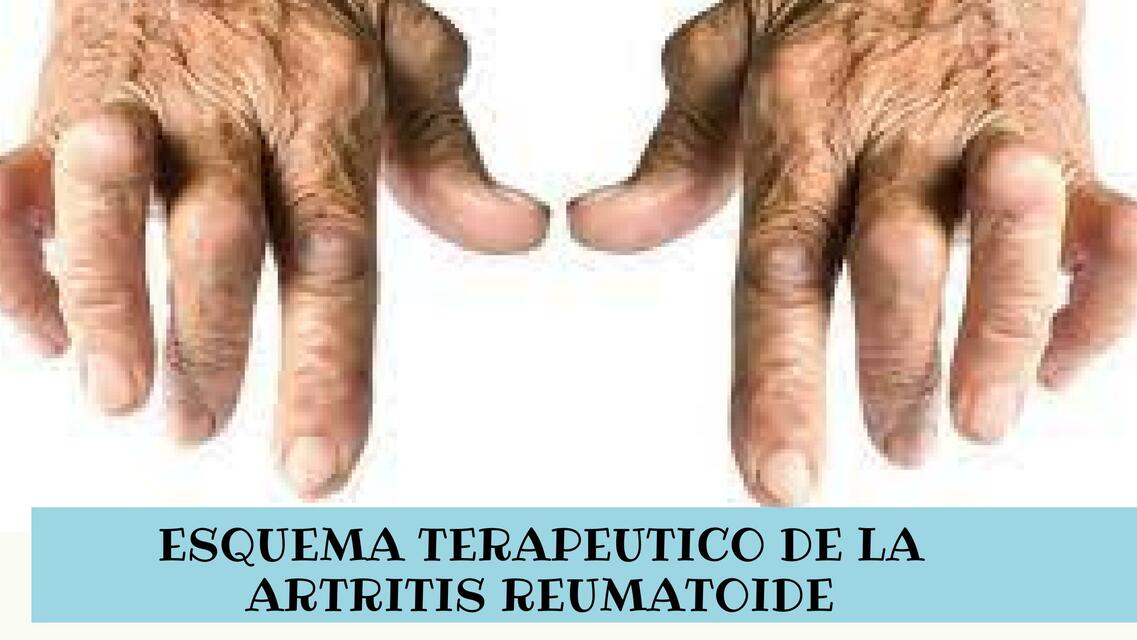 Artritis Reumatoide 