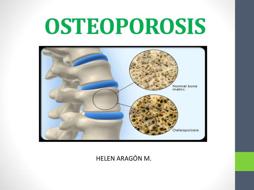 Osteoporosis 