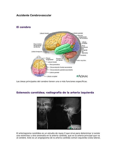 Accidente Cerebrovascular