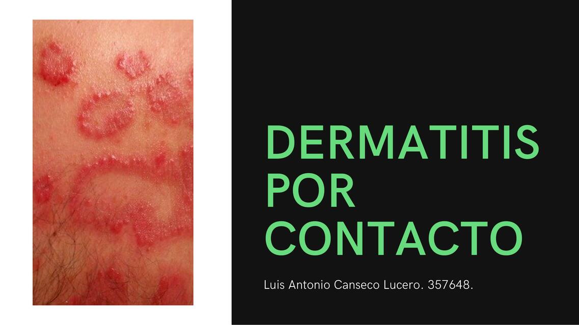 Dermatitis por Contacto 