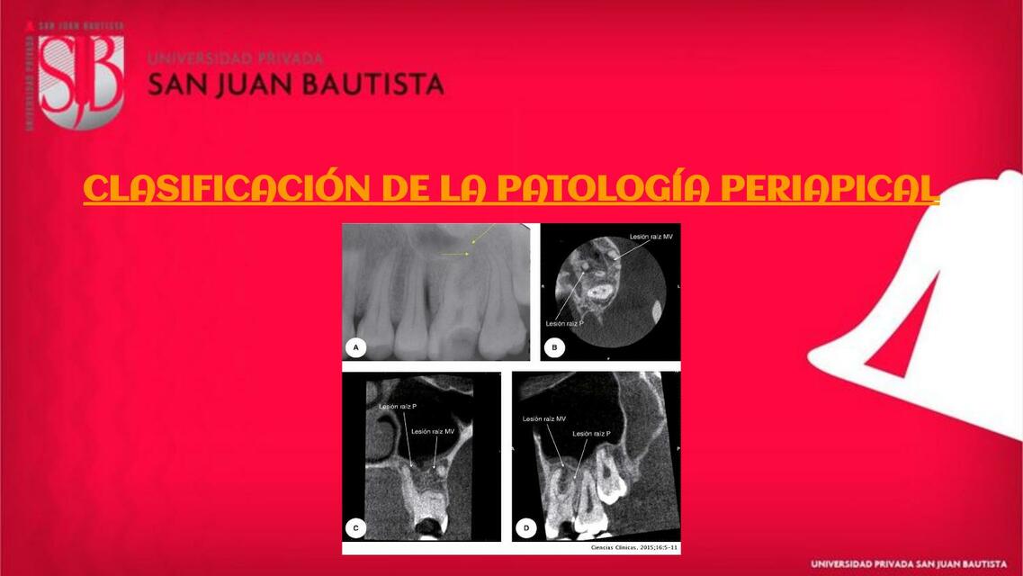 Clasificación de la patología periapical