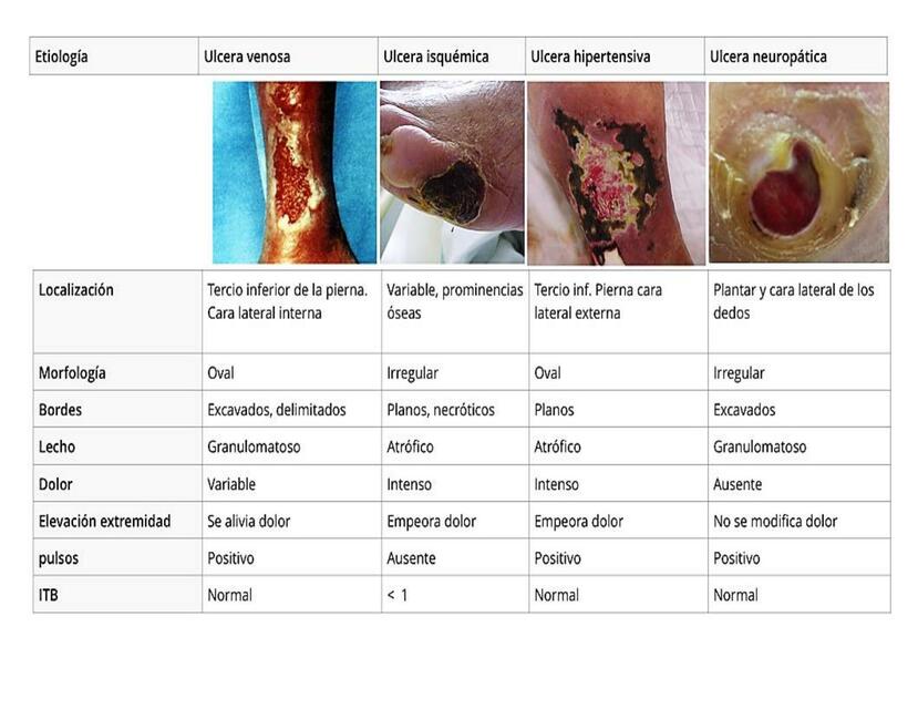 Cuadro ulceras