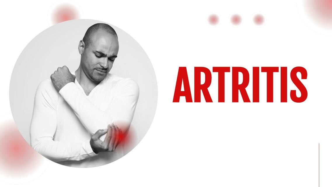 Artritis