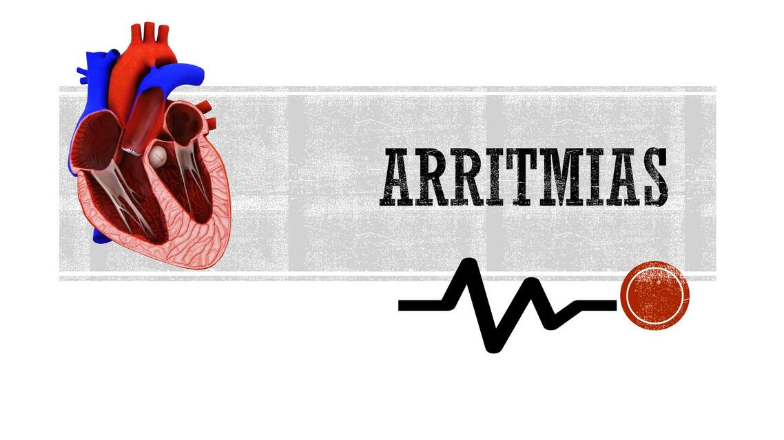 Arritmias