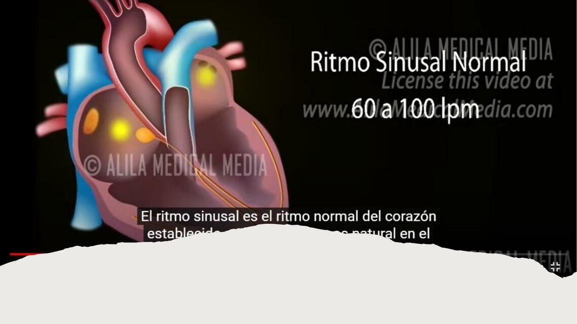 Arritmias cardiacas