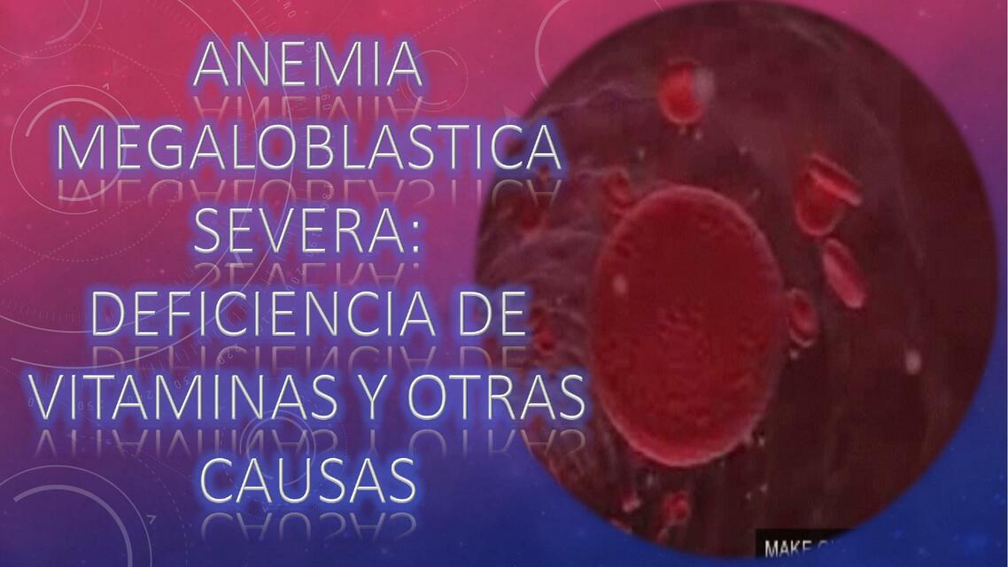 Anemia Megaloblástica Severa 