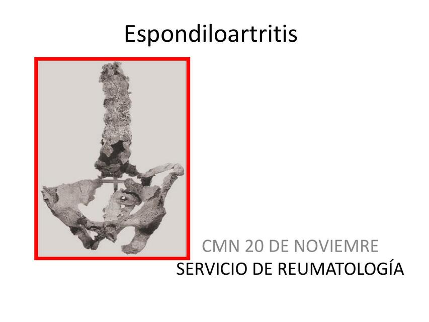 Espondiloartropatias