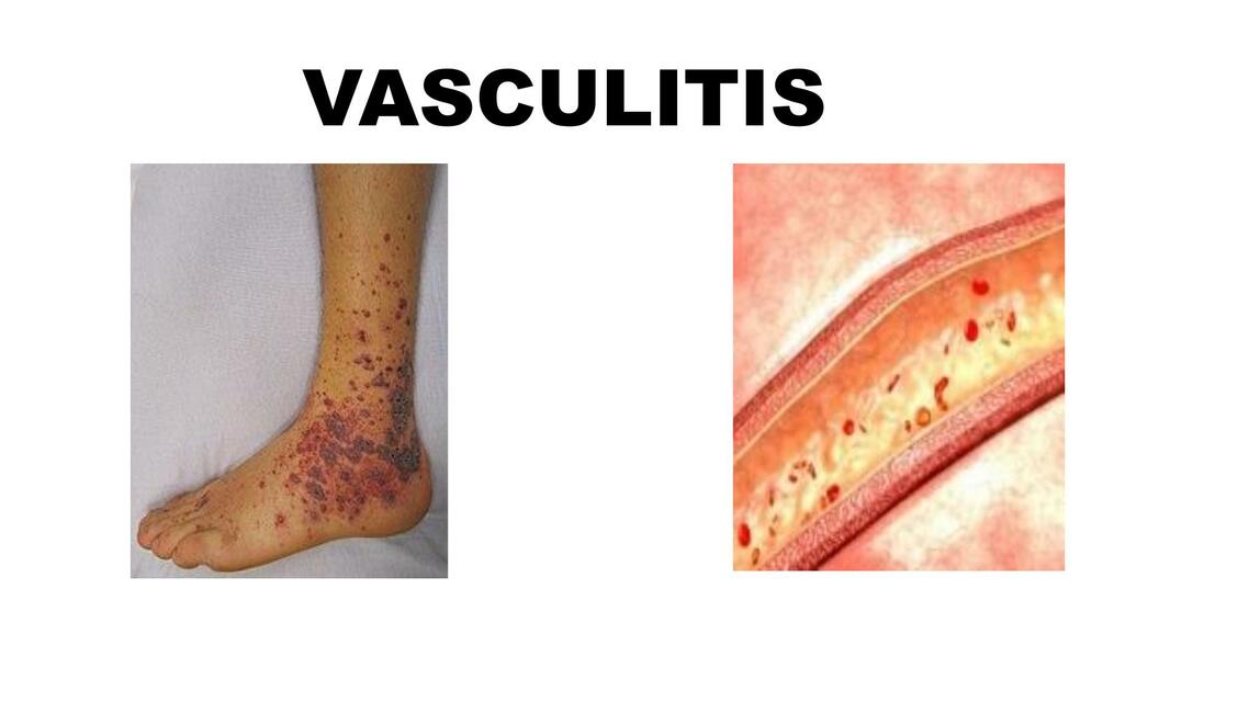 Vasculitis y Fenómeno de Raynaud