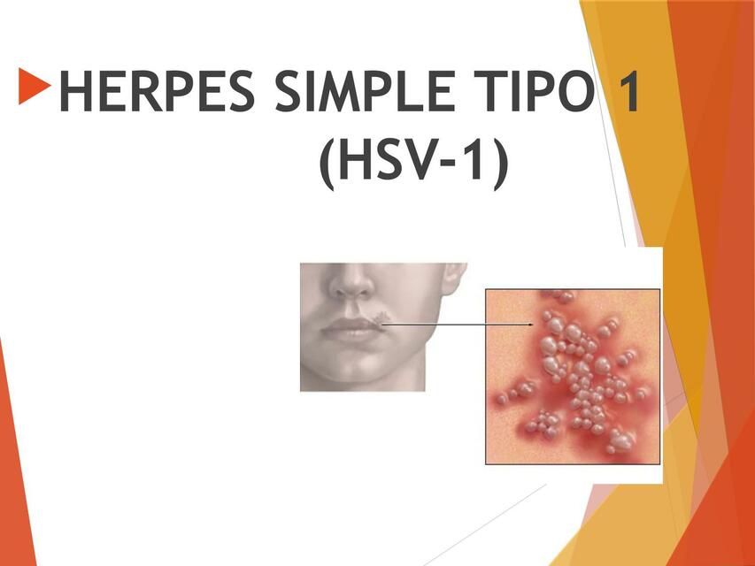 Herpes Simple Tipo 1 (HSV-1)