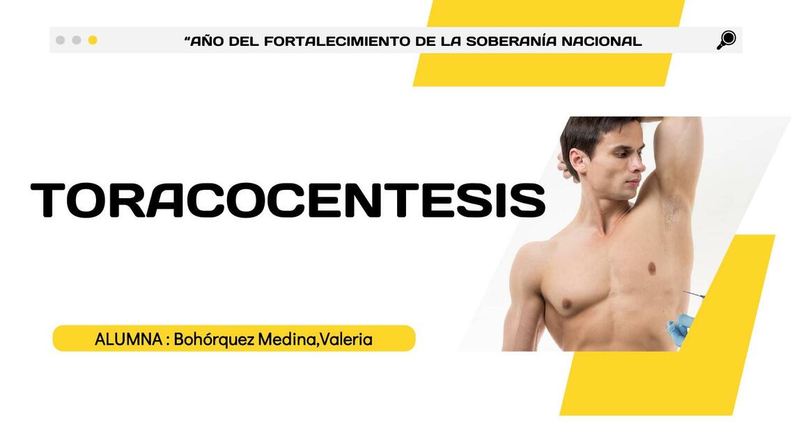 Toracocentesis 