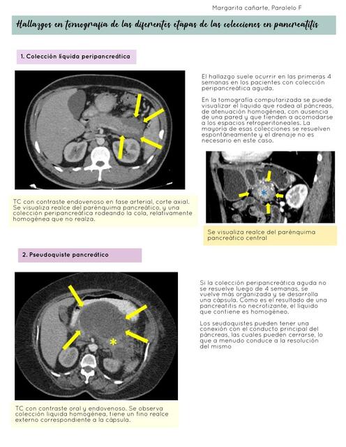 Hallazgos en Tomografía de las Diferentes Etapas de las Colecciones en Pancreatitis