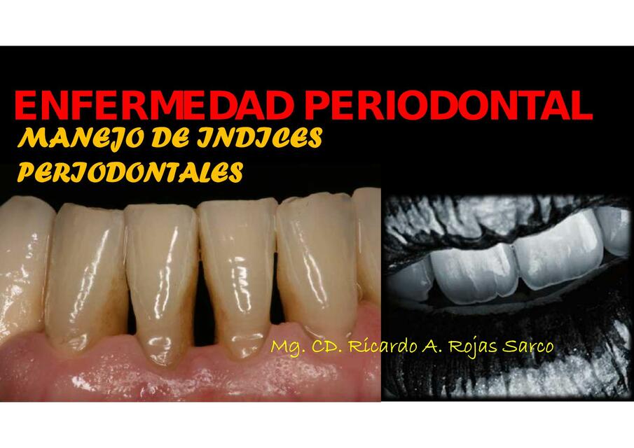 Enfermedad Periodontal 