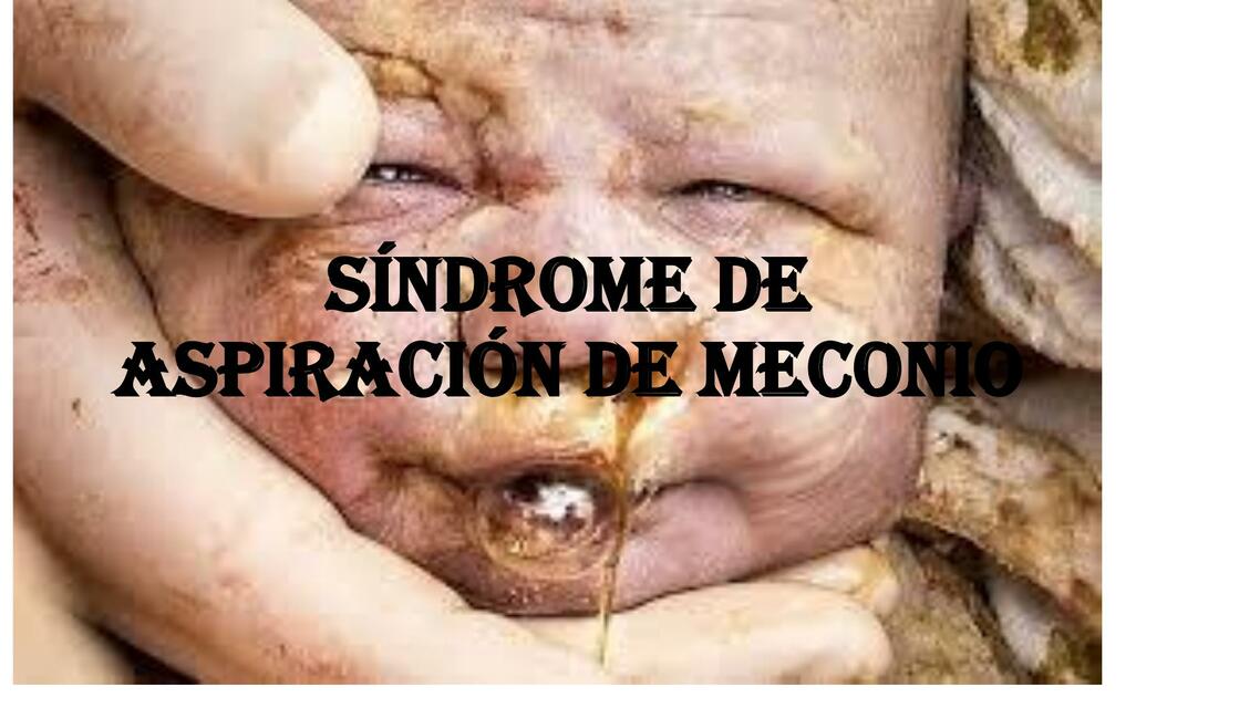 Síndrome de aspiración de meconio