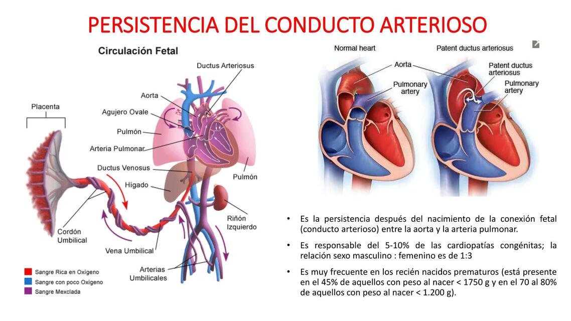 Persistencia del Conducto Arterioso