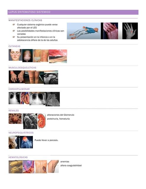 Lupus Eritematoso Sistémico y Artritis Idiopatica Juvenil