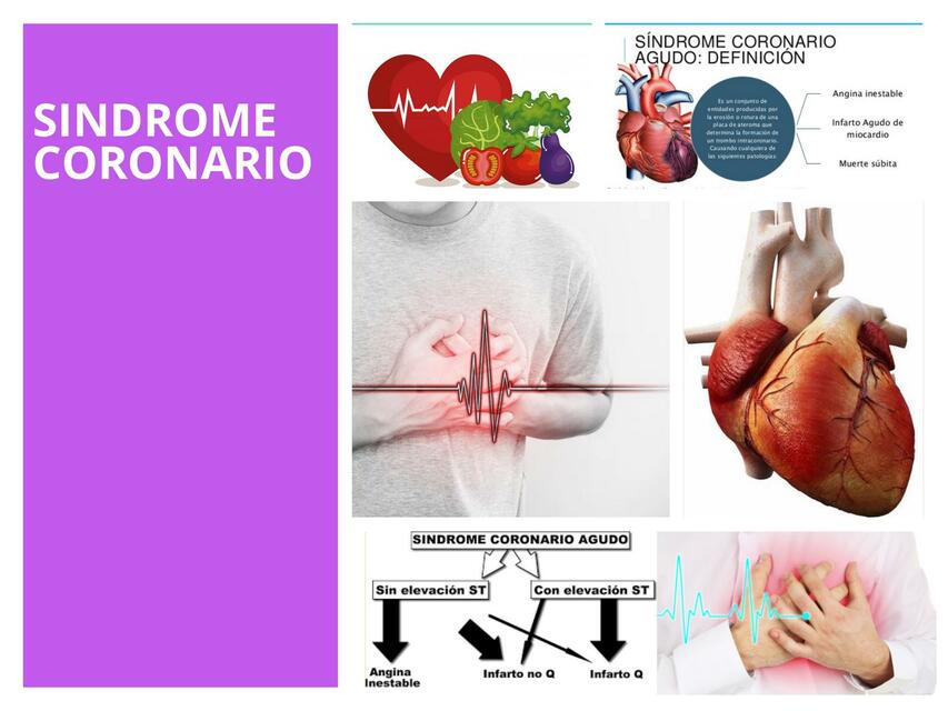 Síndrome Coronario 