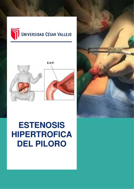 Estenosis Hipertrófica del Piloro 