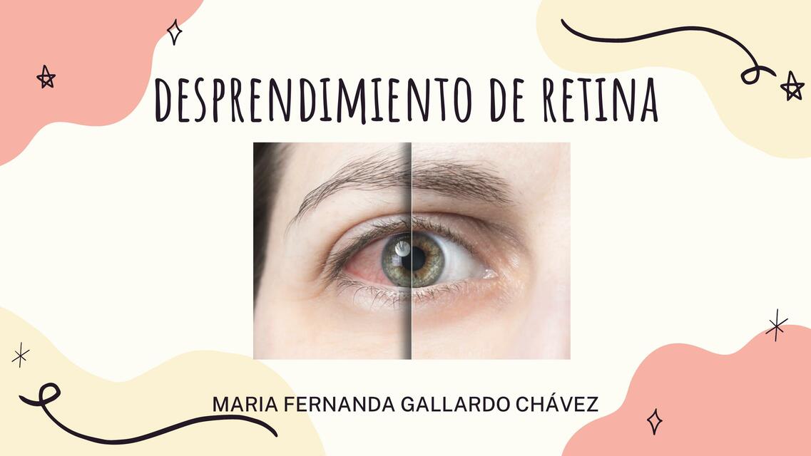 Desprendimiento de Retina