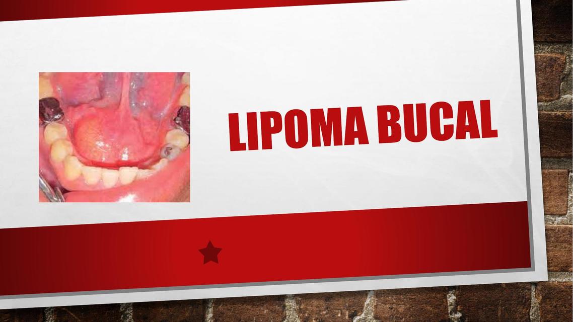 Lipoma Bucal