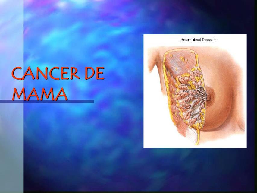 Cáncer de Mama