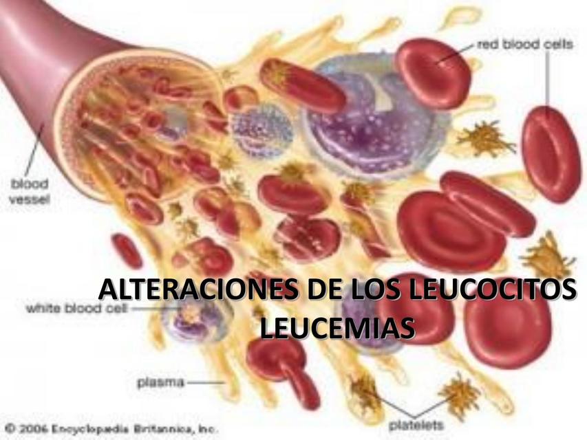 Alteraciones de los Leucocitos