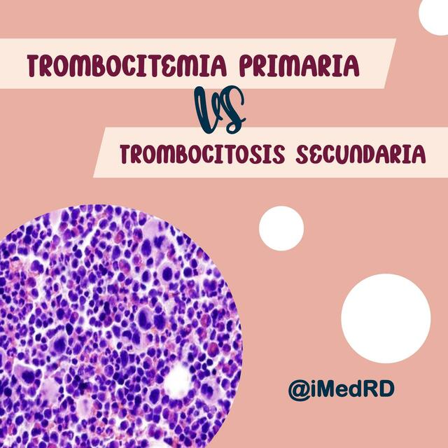 Trombocitemia y Trombocitosis