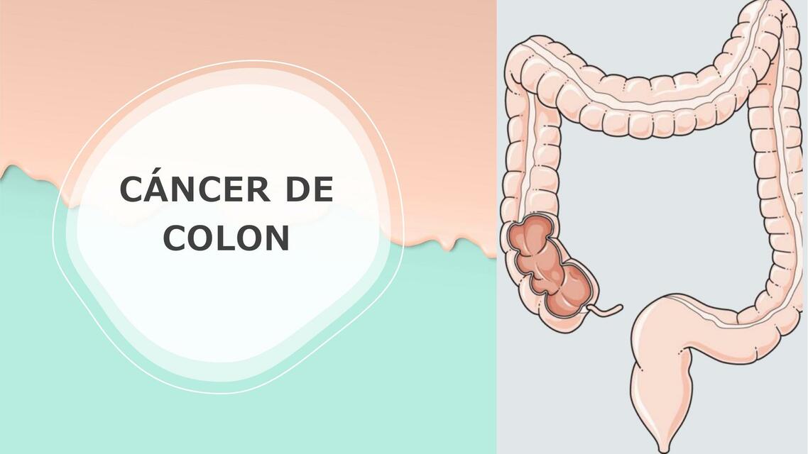 Cáncer de Colon 