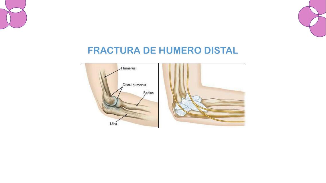 Fractura de Húmero Distal 