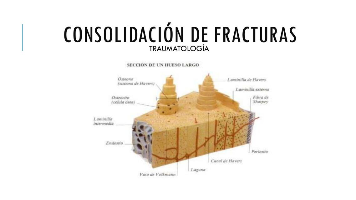 Consolidación de Fracturas 